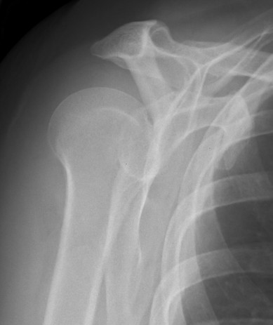 Scapula Lateral Posterior Shoulder Dislocation